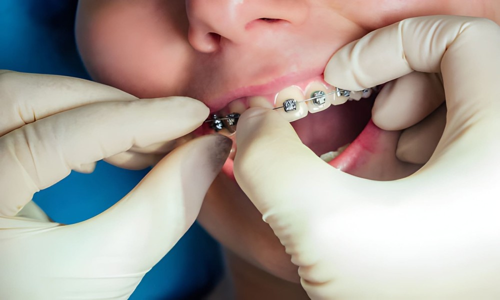 Orthodontist’s Guide to Elastics in Braces Treatment